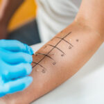 Skin Prick Allergy Testing
