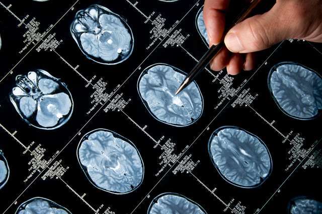 Brain Cancer Treatment Options
