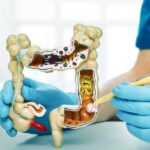 Colon Cancer Surgery