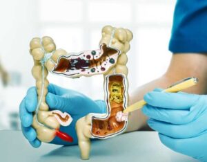 Colon Cancer Surgery