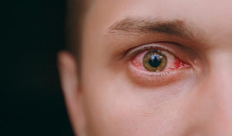 Common Causes of Red Eyes