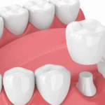 Custom Crowns