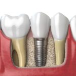 Dental Implants Over Traditional Options