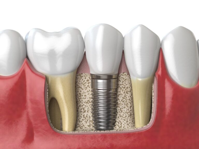 Dental Implants Over Traditional Options