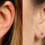 Earlobe Repair
