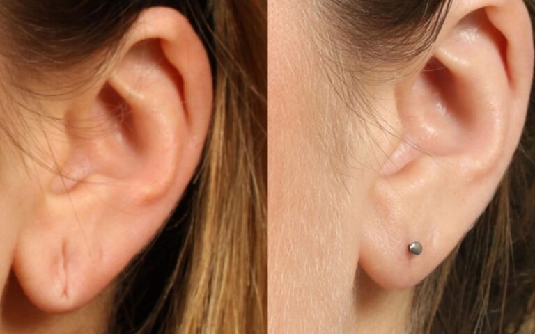 Earlobe Repair