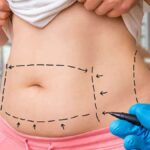 Effects of a Tummy Tuck