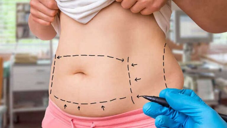 Effects of a Tummy Tuck
