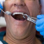 Healing Process After Tooth Extractions