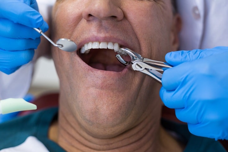 Healing Process After Tooth Extractions