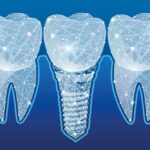 Innovations in Dental Implant Technology