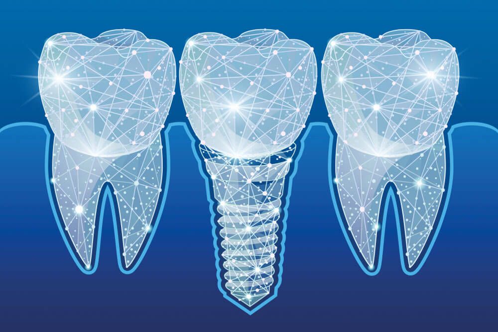 Innovations in Dental Implant Technology