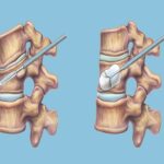 Kyphoplasty Procedure
