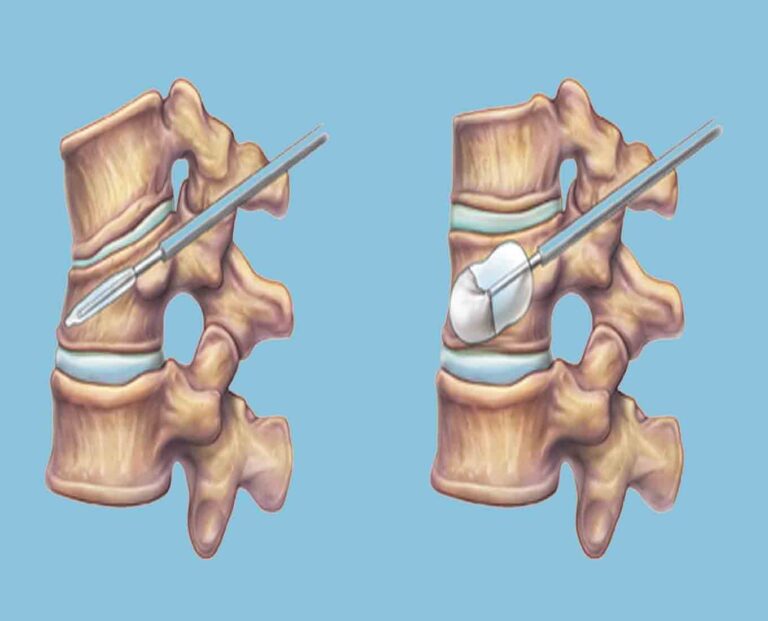 Kyphoplasty Procedure