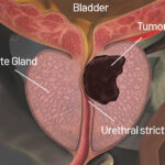 Prostate Cancer
