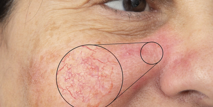 Spider Veins