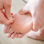 Treatments for Plantar Warts