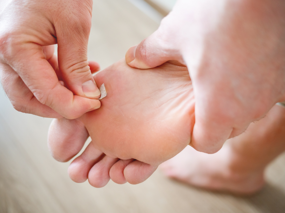 Treatments for Plantar Warts