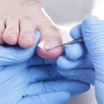 When Is a Podiatrist Needed for Toenail Issues?